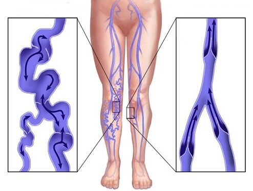 Porovnanie žíl postihnutých kŕčou a žilami po použití Veniselle