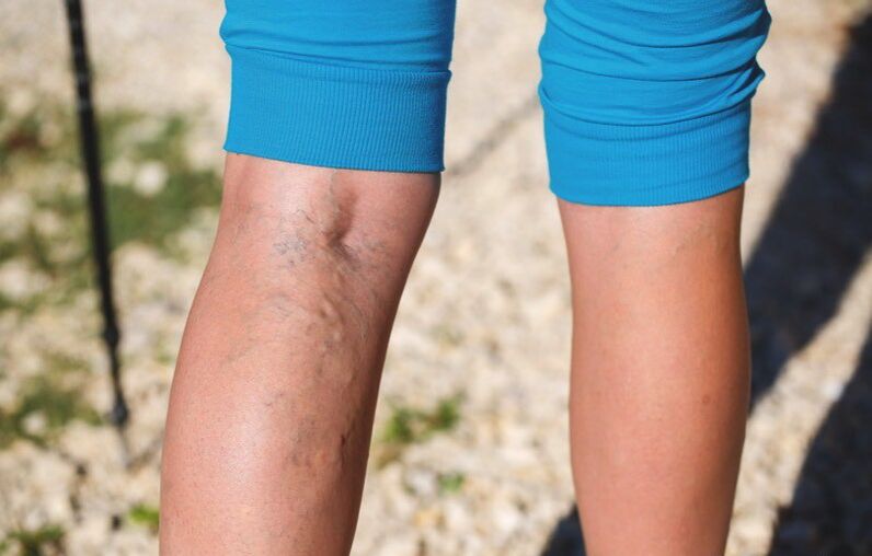 Poškodenie dolných končatín