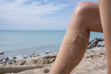 Kŕčové žily na nohách