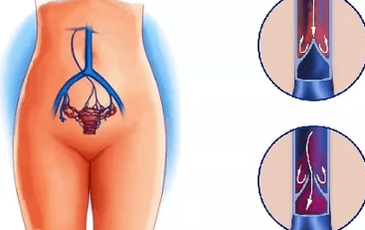 Dôvody rozvoja kŕčových žíl panvy