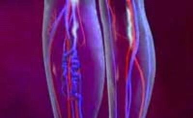 Príčiny a liečba kŕčových žíl