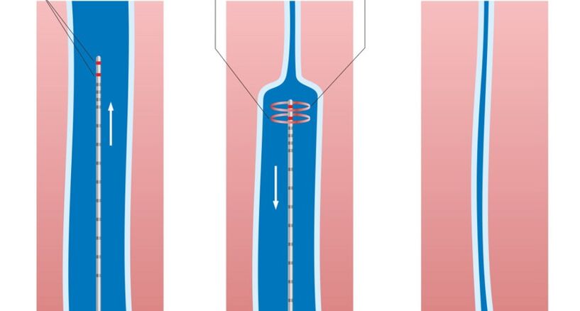 laserové ošetrenie kŕčových žíl na nohách