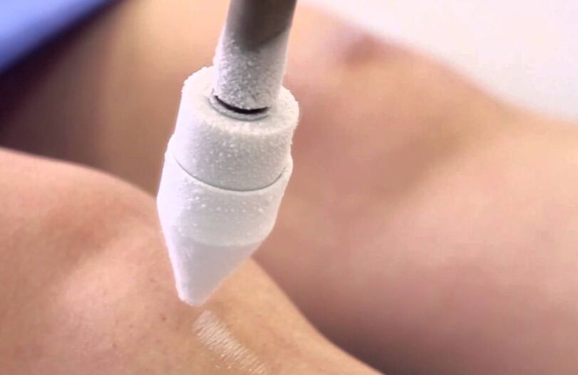 liečba kŕčových žíl na nohách kryoterapiou