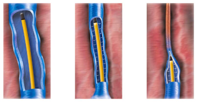 rádiofrekvenčná ablácia ako metóda liečby kŕčových žíl